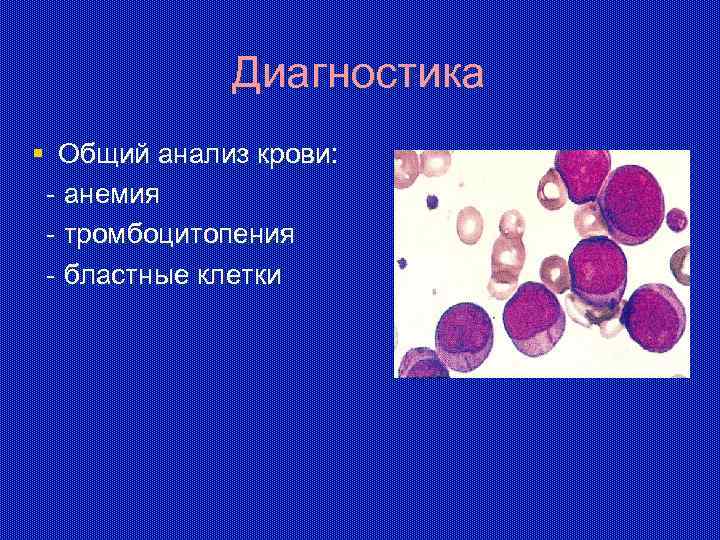 Диагностика § Общий анализ крови: - анемия - тромбоцитопения - бластные клетки 