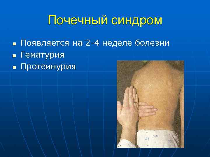 Почечный синдром n n n Появляется на 2 -4 неделе болезни Гематурия Протеинурия 