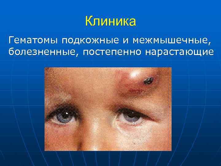 Клиника Гематомы подкожные и межмышечные, болезненные, постепенно нарастающие 