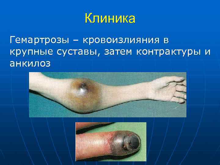 Клиника Гемартрозы – кровоизлияния в крупные суставы, затем контрактуры и анкилоз 