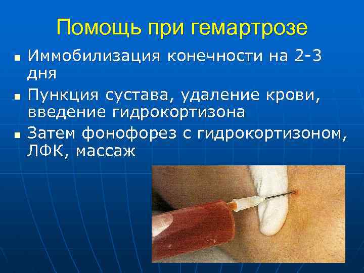 Помощь при гемартрозе n n n Иммобилизация конечности на 2 -3 дня Пункция сустава,
