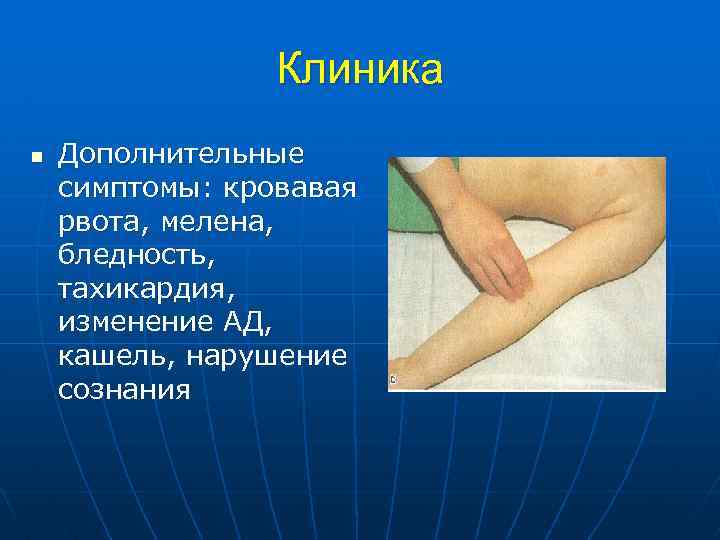 Клиника n Дополнительные симптомы: кровавая рвота, мелена, бледность, тахикардия, изменение АД, кашель, нарушение сознания