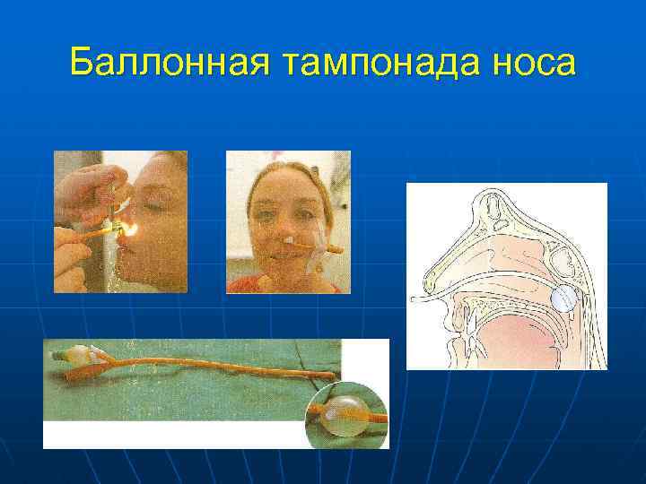 Баллонная тампонада носа 