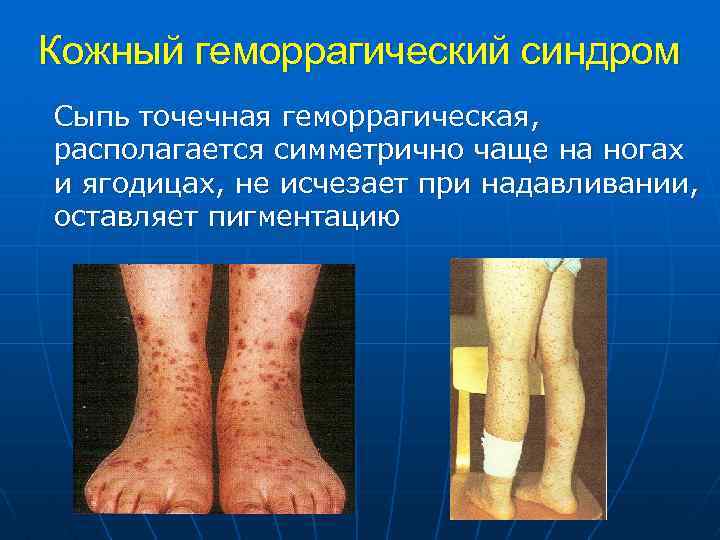 Кожный геморрагический синдром Сыпь точечная геморрагическая, располагается симметрично чаще на ногах и ягодицах, не