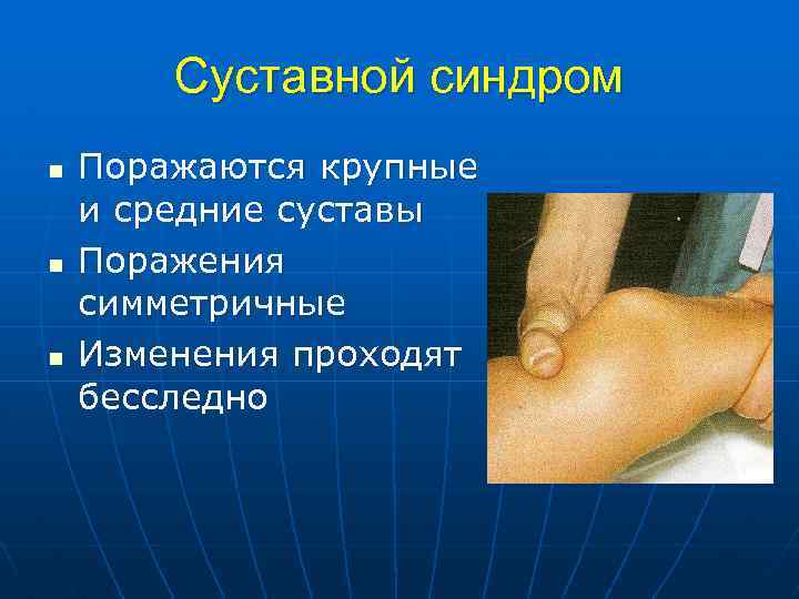 Суставной синдром n n n Поражаются крупные и средние суставы Поражения симметричные Изменения проходят