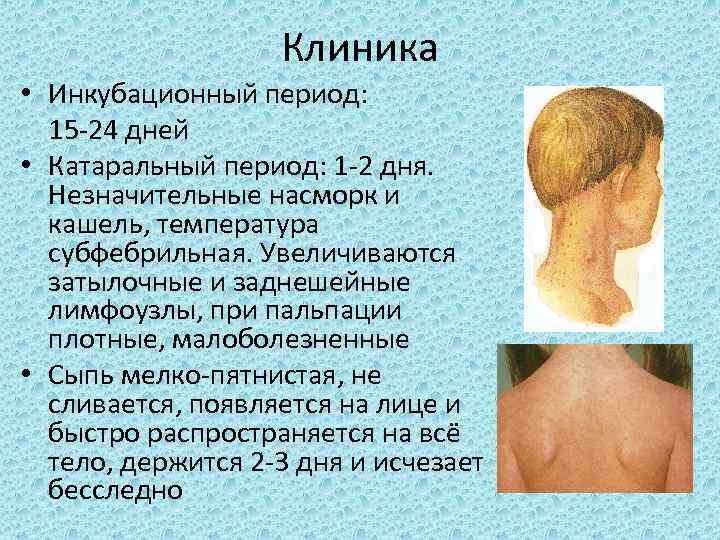 Клиника • Инкубационный период: 15 -24 дней • Катаральный период: 1 -2 дня. Незначительные