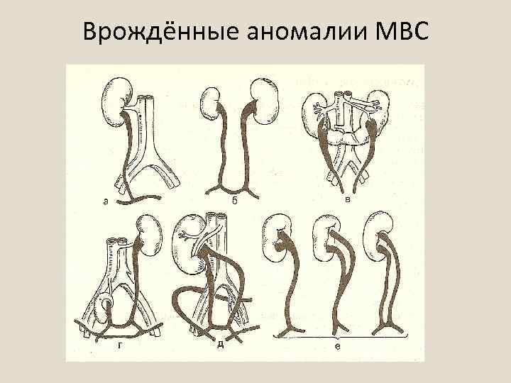 Аномалии развития почки картинки