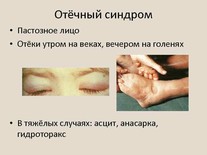 Отёчный синдром • Пастозное лицо • Отёки утром на веках, вечером на голенях •