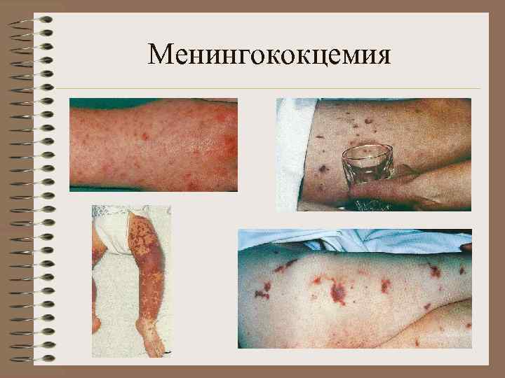 Менингококцемия 