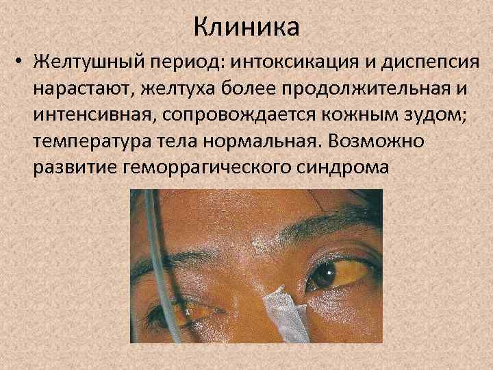 Клиника • Желтушный период: интоксикация и диспепсия нарастают, желтуха более продолжительная и интенсивная, сопровождается