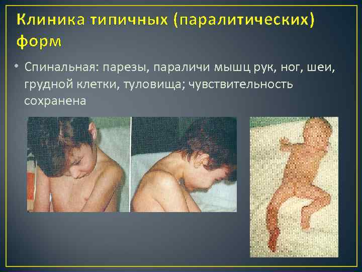 Клиника типичных (паралитических) форм • Спинальная: парезы, параличи мышц рук, ног, шеи, грудной клетки,