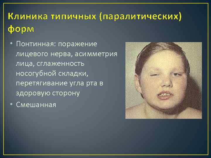 Клиника типичных (паралитических) форм • Понтинная: поражение лицевого нерва, асимметрия лица, сглаженность носогубной складки,