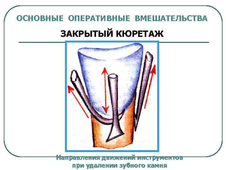 ОСНОВНЫЕ ОПЕРАТИВНЫЕ ВМЕШАТЕЛЬСТВА ЗАКРЫТЫЙ КЮРЕТАЖ Направления движений инструментов при удалении зубного камня 