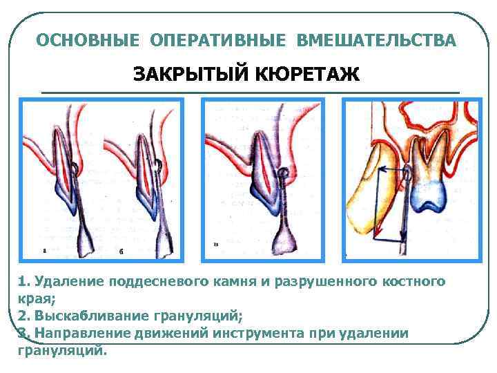 ОСНОВНЫЕ ОПЕРАТИВНЫЕ ВМЕШАТЕЛЬСТВА ЗАКРЫТЫЙ КЮРЕТАЖ 1. Удаление поддесневого камня и разрушенного костного края; 2.