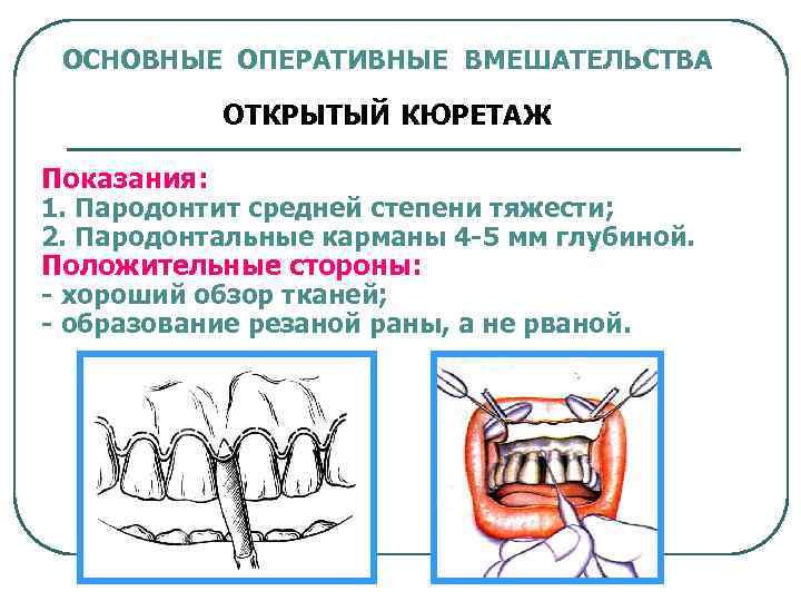 ОСНОВНЫЕ ОПЕРАТИВНЫЕ ВМЕШАТЕЛЬСТВА ОТКРЫТЫЙ КЮРЕТАЖ Показания: 1. Пародонтит средней степени тяжести; 2. Пародонтальные карманы