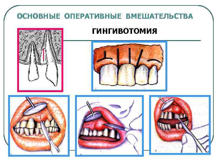 ОСНОВНЫЕ ОПЕРАТИВНЫЕ ВМЕШАТЕЛЬСТВА ГИНГИВОТОМИЯ 
