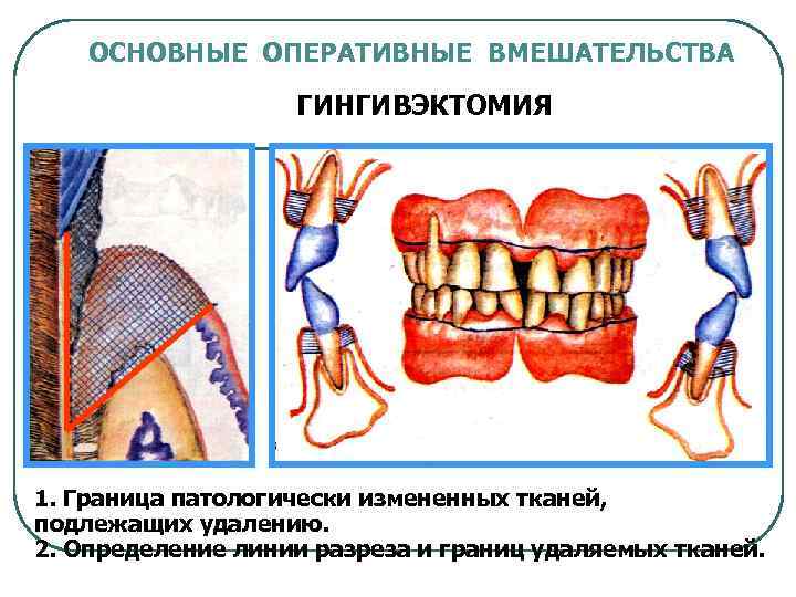 ОСНОВНЫЕ ОПЕРАТИВНЫЕ ВМЕШАТЕЛЬСТВА ГИНГИВЭКТОМИЯ 1. Граница патологически измененных тканей, подлежащих удалению. 2. Определение линии