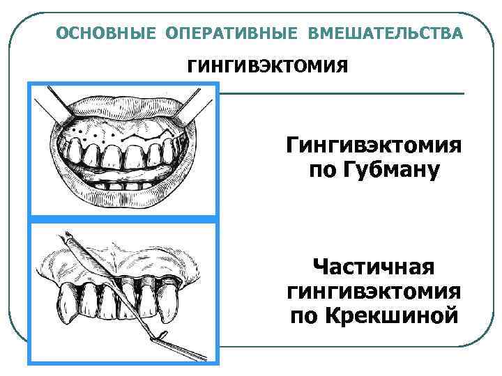 ОСНОВНЫЕ ОПЕРАТИВНЫЕ ВМЕШАТЕЛЬСТВА ГИНГИВЭКТОМИЯ Гингивэктомия по Губману Частичная гингивэктомия по Крекшиной 