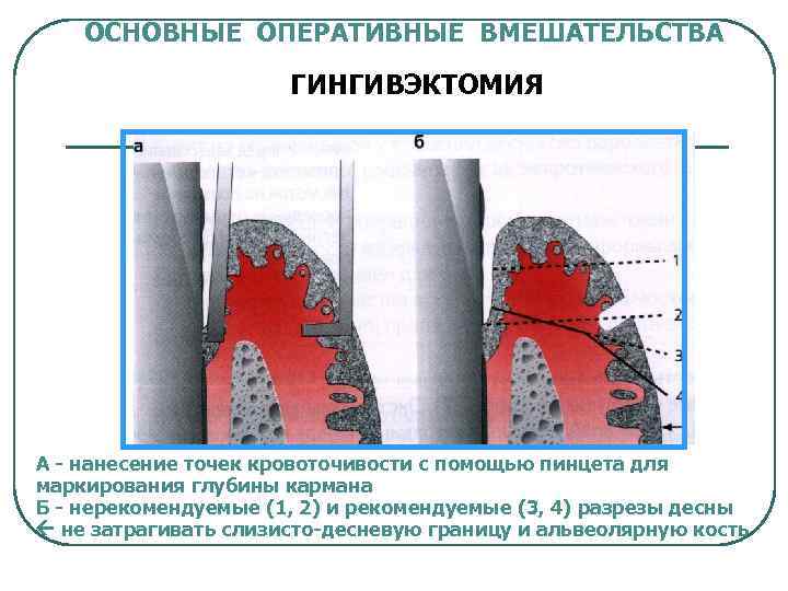 ОСНОВНЫЕ ОПЕРАТИВНЫЕ ВМЕШАТЕЛЬСТВА ГИНГИВЭКТОМИЯ А - нанесение точек кровоточивости с помощью пинцета для маркирования