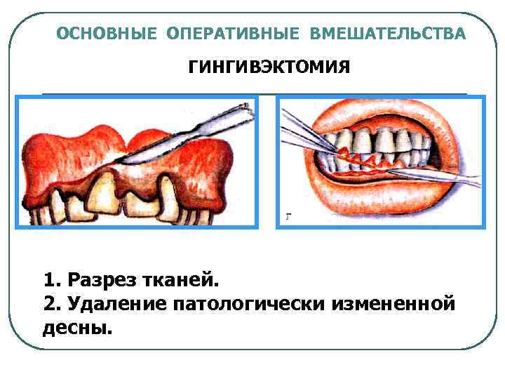 Гингивэктомия это. Радикальная гингивэктомия. Гингивэктомия осложнения.