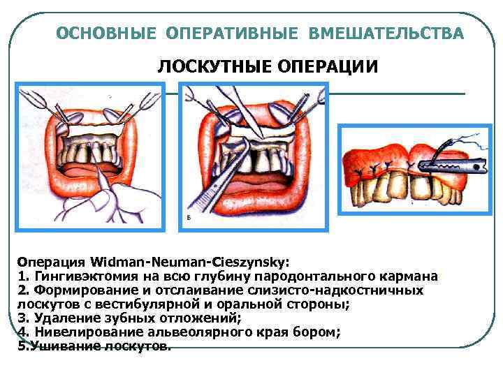 Общие принципы пародонтальной хирургии презентация