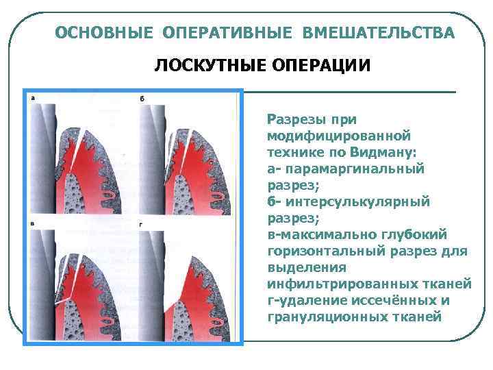 ОСНОВНЫЕ ОПЕРАТИВНЫЕ ВМЕШАТЕЛЬСТВА ЛОСКУТНЫЕ ОПЕРАЦИИ Разрезы при модифицированной технике по Видману: а- парамаргинальный разрез;