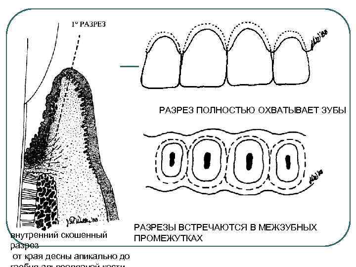 РАЗРЕЗ ПОЛНОСТЬЮ ОХВАТЫВАЕТ ЗУБЫ внутренний скошенный разрез от края десны апикально до РАЗРЕЗЫ ВСТРЕЧАЮТСЯ