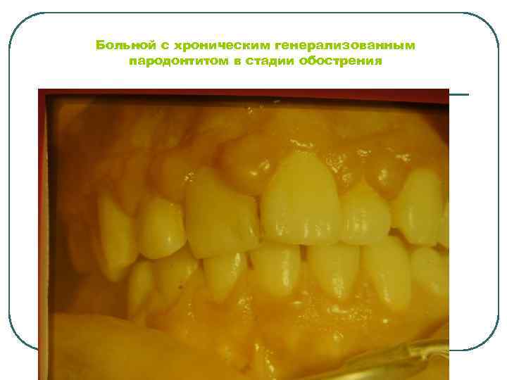 Больной с хроническим генерализованным пародонтитом в стадии обострения 