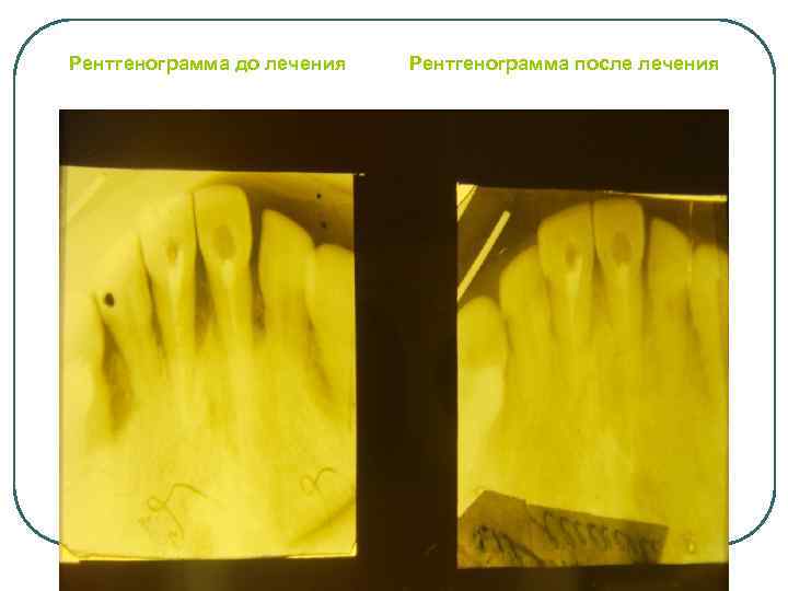 Рентгенограмма до лечения Рентгенограмма после лечения 