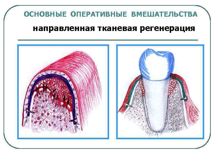 Направленная костная регенерация презентация