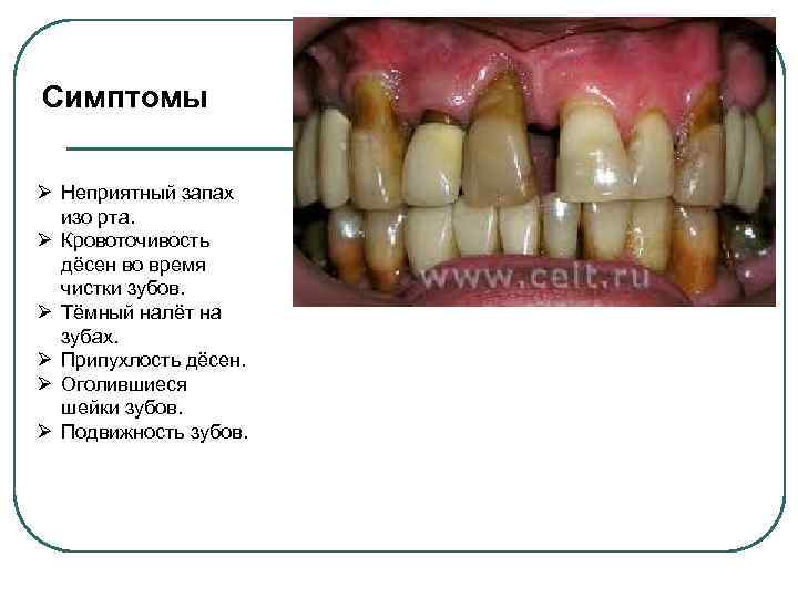 Симптомы Ø Неприятный запах изо рта. Ø Кровоточивость дёсен во время чистки зубов. Ø