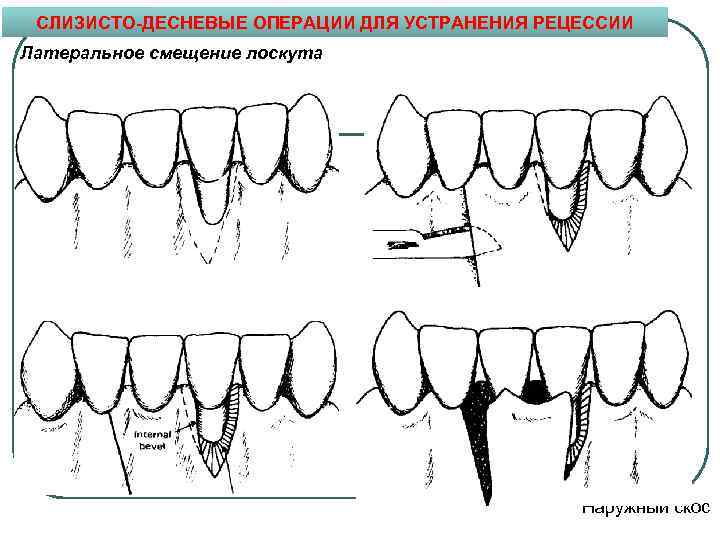 Лоскут зубы. Методика латерально смещенного лоскута. Закрытие рецессии десны коронально смещенный лоскут. Пластика рецессии десны латеральным смещением лоскута. Рецессия десны Лоскутная операция.