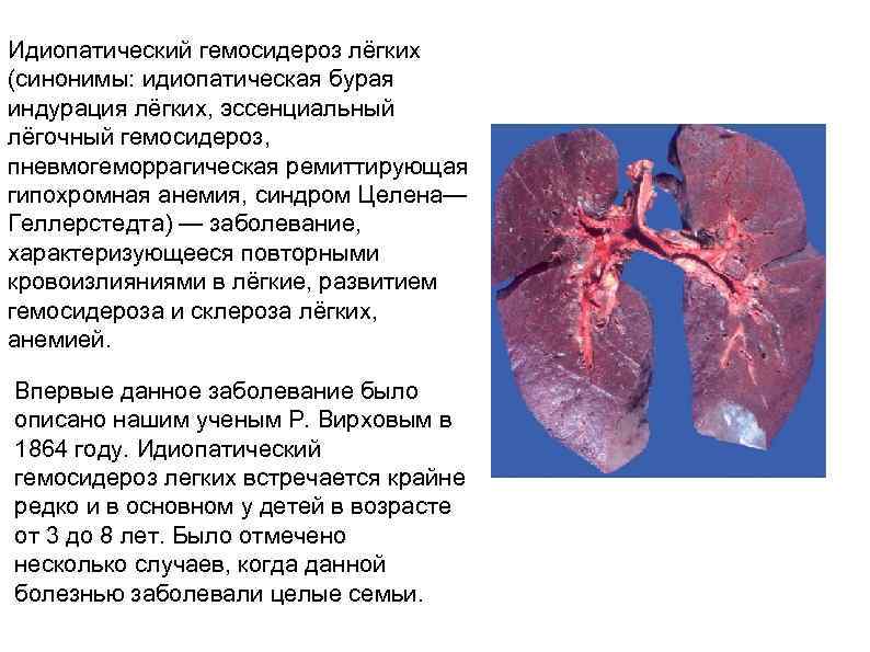 Идиопатический гемосидероз лёгких (синонимы: идиопатическая бурая индурация лёгких, эссенциальный лёгочный гемосидероз, пневмогеморрагическая ремиттирующая гипохромная