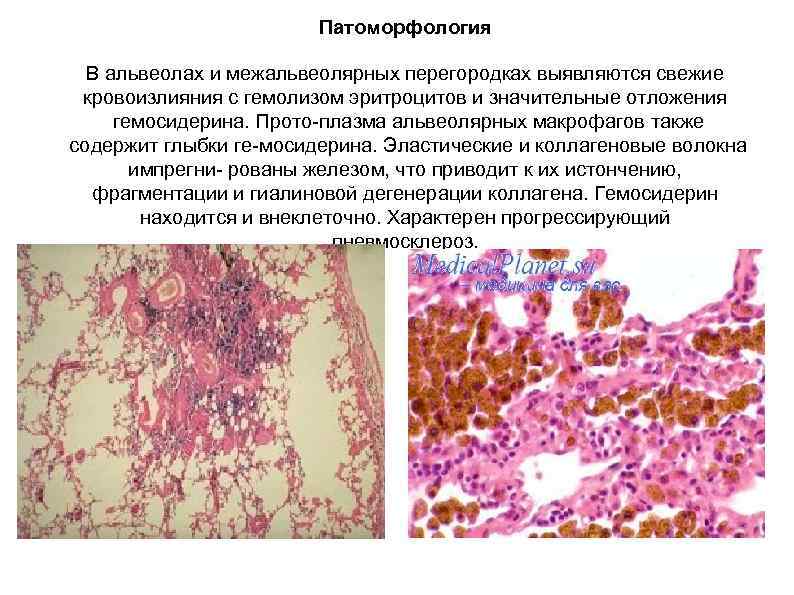 Патоморфология В альвеолах и межальвеолярных перегородках выявляются свежие кровоизлияния с гемолизом эритроцитов и значительные