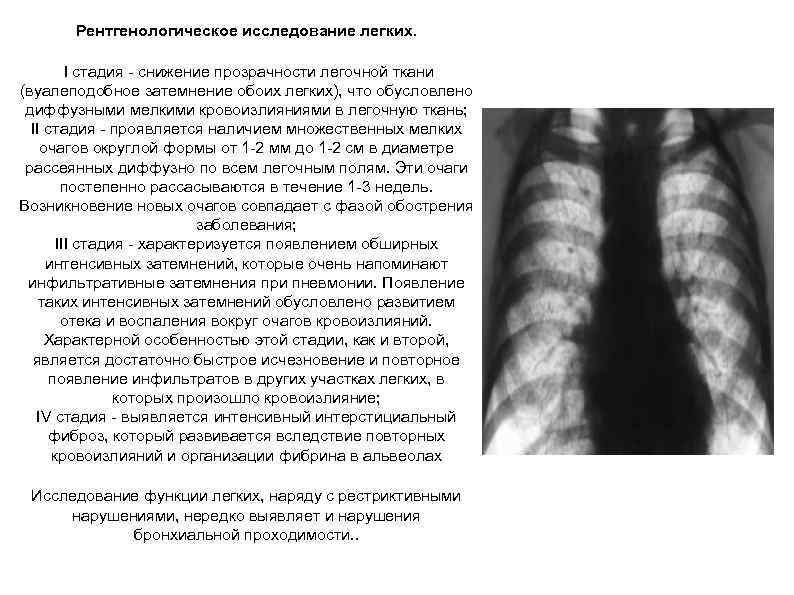 Рентгенологическое исследование легких. I стадия снижение прозрачности легочной ткани (вуалеподобное затемнение обоих легких), что