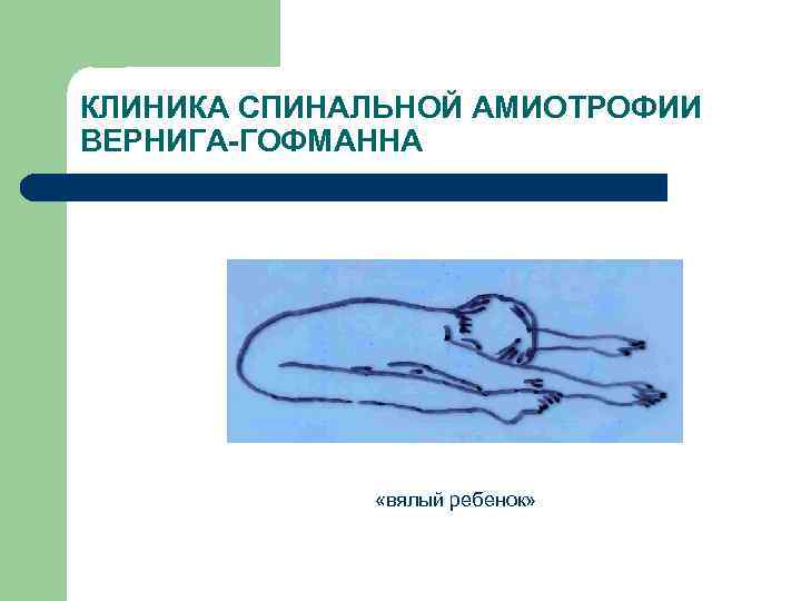 КЛИНИКА СПИНАЛЬНОЙ АМИОТРОФИИ ВЕРНИГА-ГОФМАННА «вялый ребенок» 