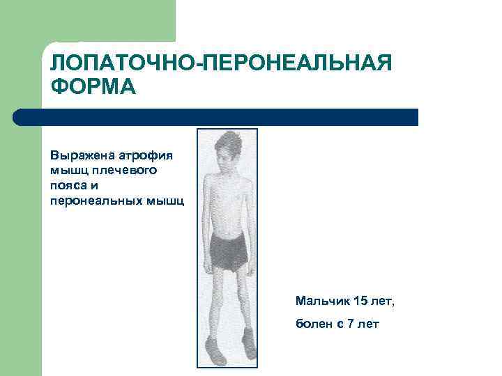 ЛОПАТОЧНО-ПЕРОНЕАЛЬНАЯ ФОРМА Выражена атрофия мышц плечевого пояса и перонеальных мышц Мальчик 15 лет, болен