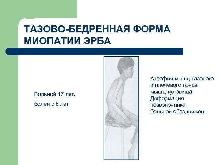 ТАЗОВО-БЕДРЕННАЯ ФОРМА МИОПАТИИ ЭРБА Больной 17 лет, болен с 6 лет Атрофия мышц тазового