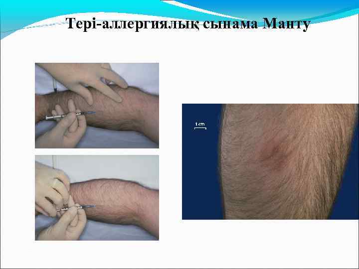 Тері-аллергиялық сынама Манту 