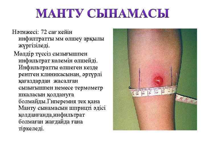 Нәтижесі: 72 сағ кейін инфилтратты мм өлшеу арқылы жүргізіледі. Мөлдір түссіз сызығышпен инфильтрат көлемін