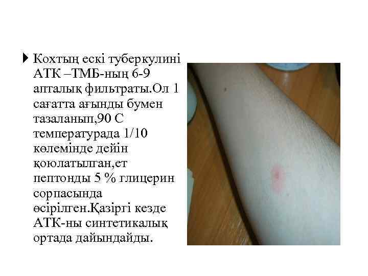  Кохтың ескі туберкулині АТК –ТМБ-ның 6 -9 апталық фильтраты. Ол 1 сағатта ағынды