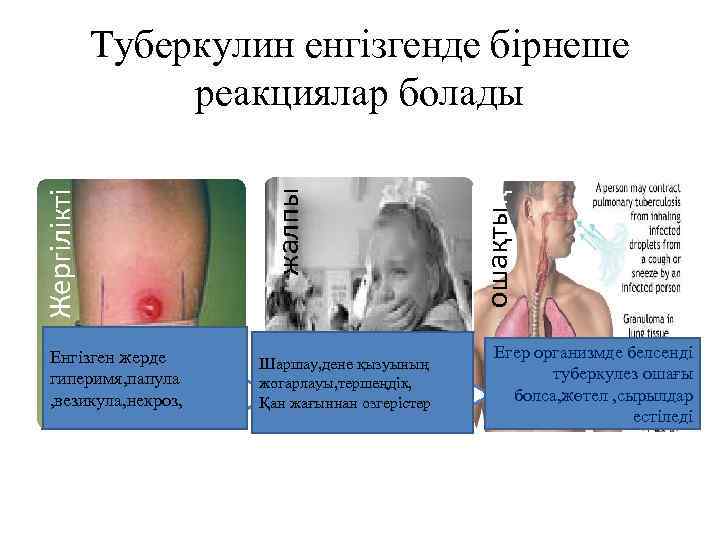 Енгізген жерде гиперимя, папула , везикула, некроз, Шаршау, дене қызуының жогарлауы, тершеңдік, Қан жағыннан