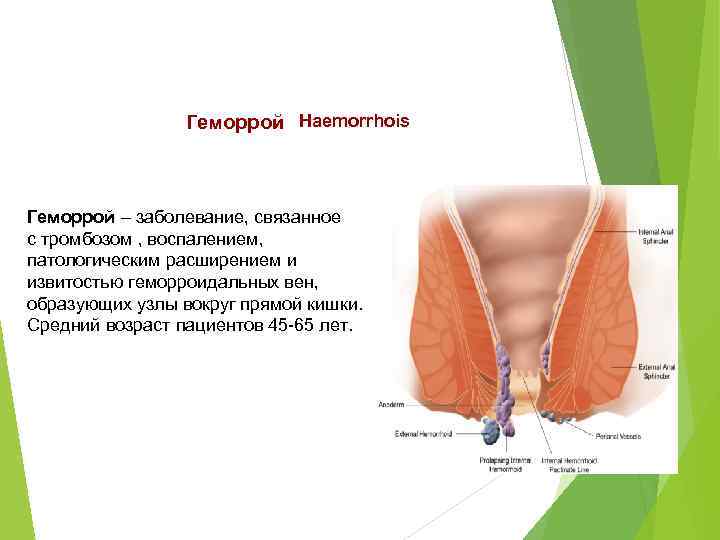 Геморрой Haemorrhois Геморрой – заболевание, связанное Геморрой с тромбозом , воспалением, патологическим расширением и