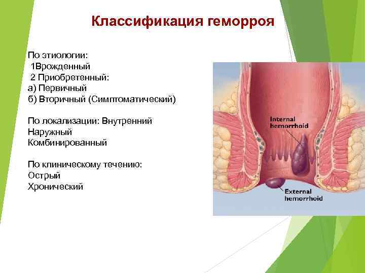 Классификация геморроя По этиологии: 1 Врожденный 2 Приобретенный: а) Первичный б) Вторичный (Симптоматический) По