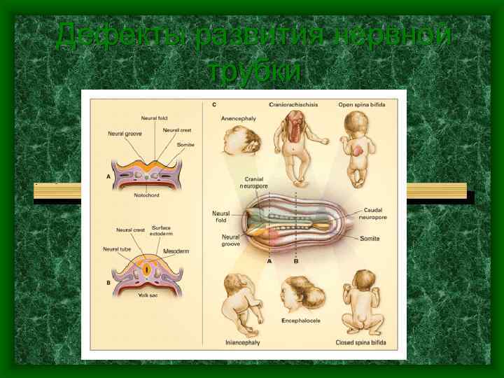 Дефекты развития нервной трубки 