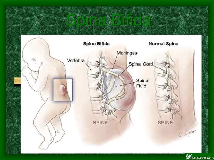 Spina Bifida 