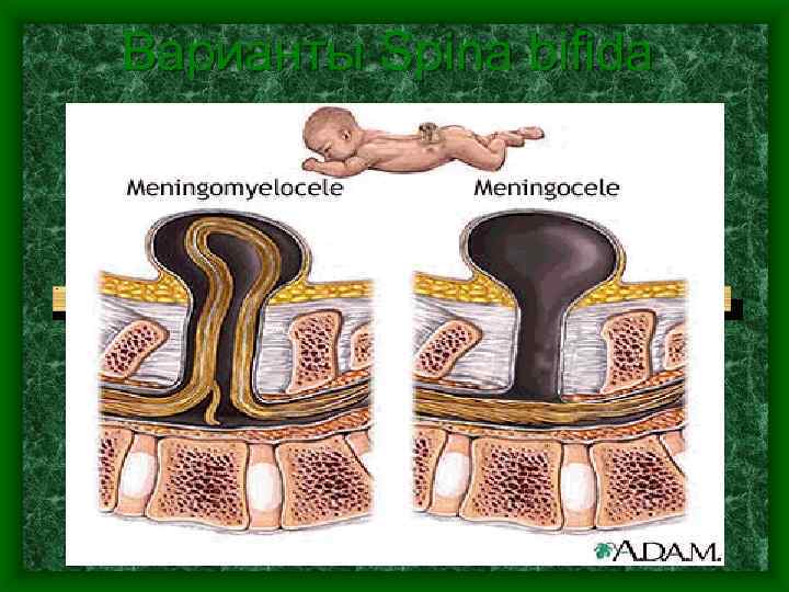 Варианты Spina bifida 