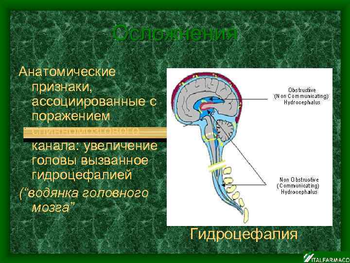 Осложнения Анатомические признаки, ассоциированные с поражением спинномозгового канала: увеличение головы вызванное гидроцефалией (“водянка головного