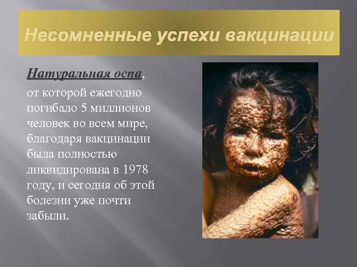 Несомненные успехи вакцинации Натуральная оспа, от которой ежегодно погибало 5 миллионов человек во всем