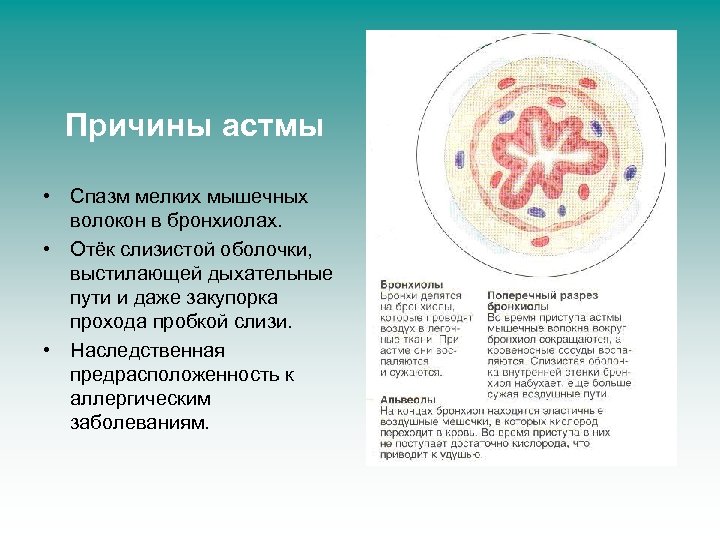 Причины астмы • Спазм мелких мышечных волокон в бронхиолах. • Отёк слизистой оболочки, выстилающей